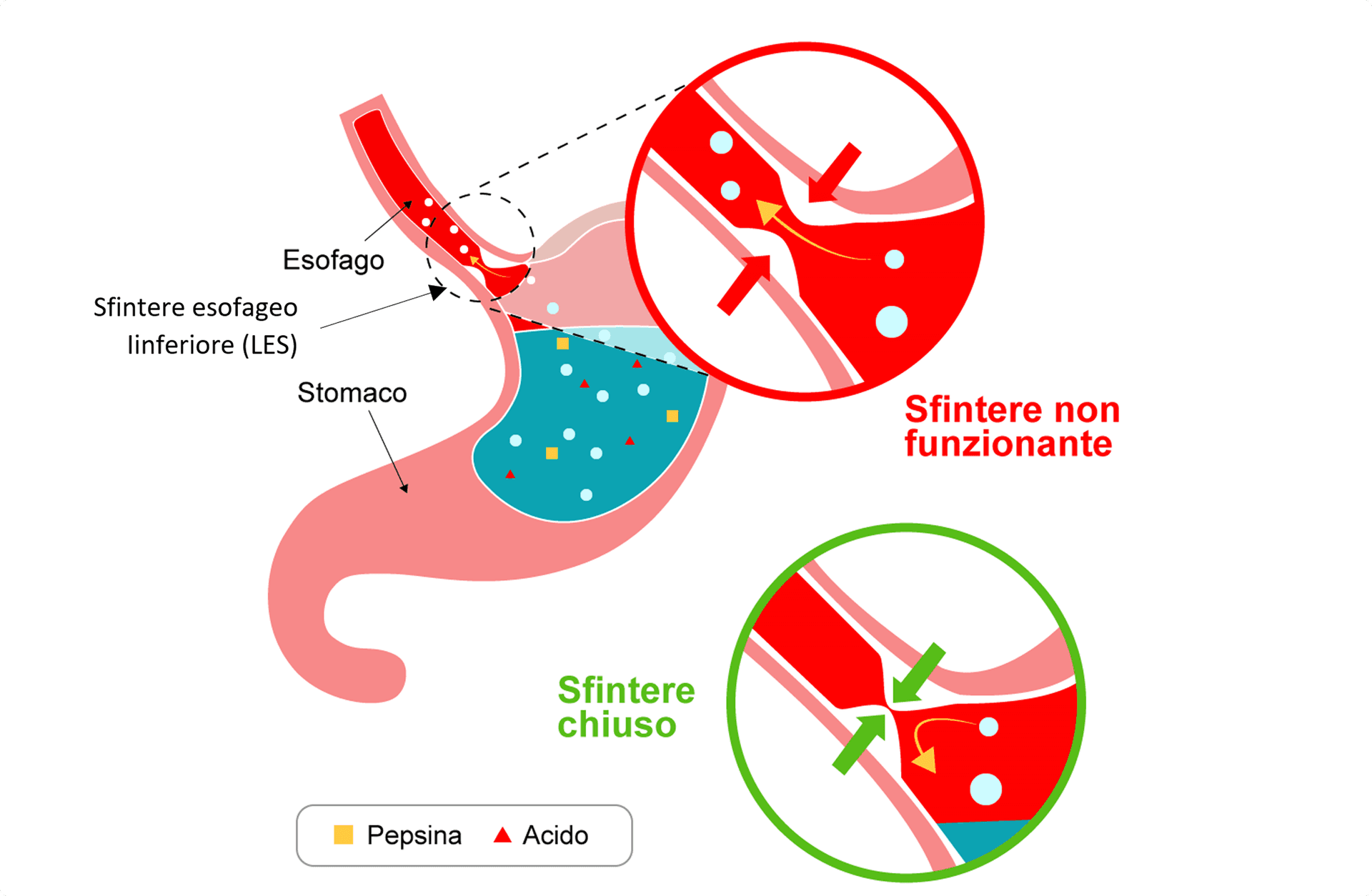 Reflusso gastroesofageo come funziona