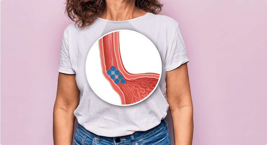 Reflusso gastroesofageo: Scopri il ruolo del Poloxamer 407