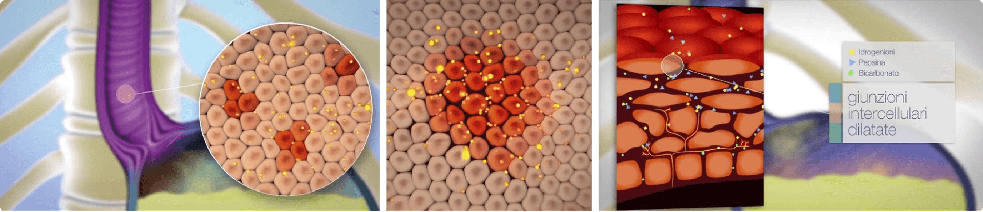 Giunzioni intercellulari dilatate