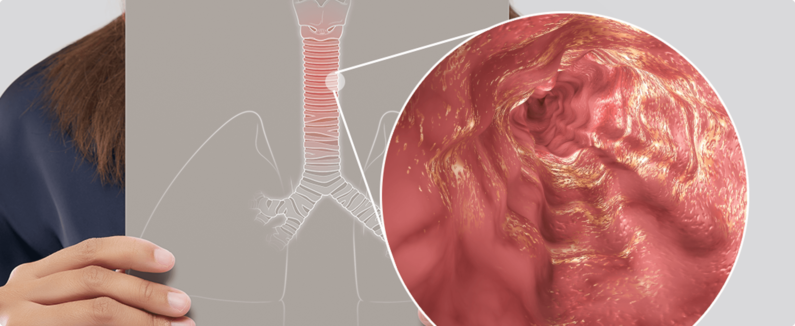 Reflusso gastro-esofageo: la mucosa danneggiata può essere uno dei motivi per cui la terapia non funziona